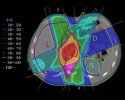 Dieses Bild zeigt die 3DCRT Mehrfeldertechnik mit Konzentration der Dosis im Bereich des Zielvolumens (ZV Zielvolumen; L Leber; D Darm; N Niere)