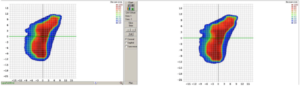 Hier sieht man auf dem rechten Bild eine gerechnete, und auf dem linken Bild die dazugehörige, am Bestrahlungsgerät, gemessene Dosisverteilung. (Software SNC Patient V.6.6.0, Fa. Sun Nuclear)