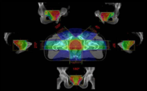 Dieses Bild zeigt die Dosisverteilung eines IMRT-Bestrahlungsplanes bei Prostatakarzinom, resultierend aus der Überlagerung von fünf intensitätsmodulierten Bestrahlungsfeldern.